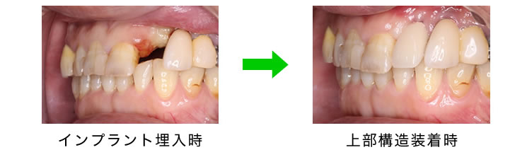 �C���v�����g